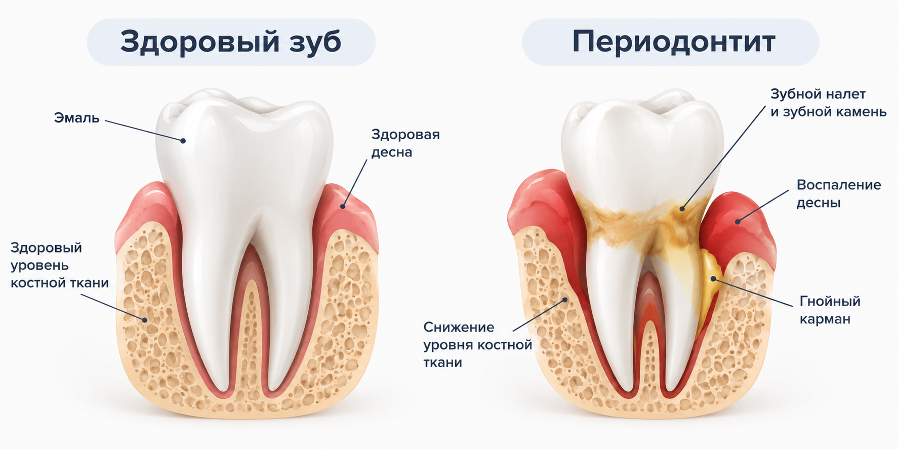 Лечение хронического периодонтита